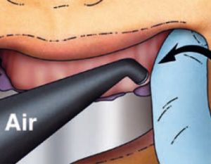 Measures facilitating removal of the impression from the mouth.